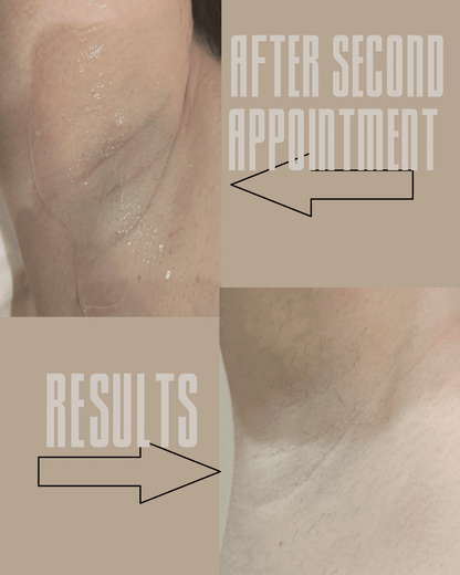 Any Bikini & Underarms - course of 6 Cork - Laser Hair Removal & Beauty | skybeautyandlaser.ie