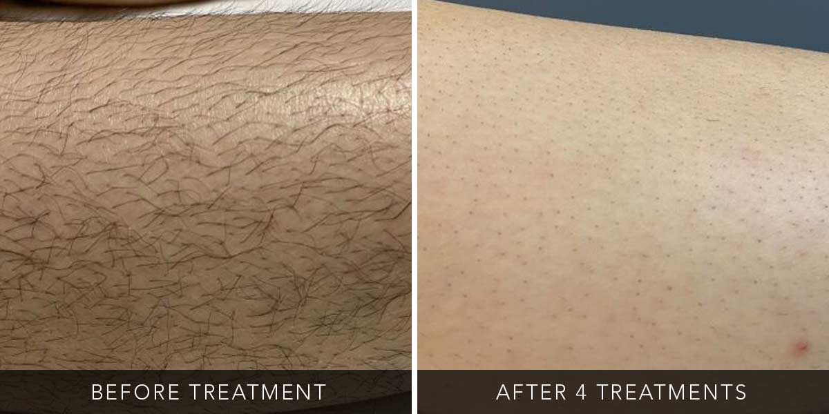 Lower Leg - course of 6 Cork - Laser Hair Removal & Beauty | skybeautyandlaser.ie