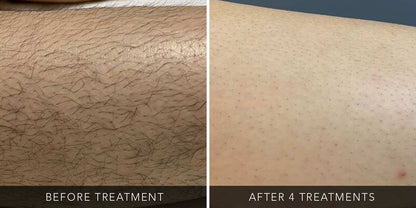 Lower Leg - course of 6 Cork - Laser Hair Removal & Beauty | skybeautyandlaser.ie